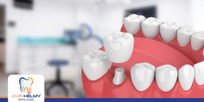 كيفية اختيار التركيبة الافضل لاسنانك